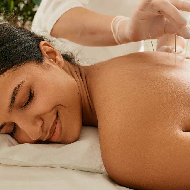 Woman on bed receiving acupuncture treatment for back issue.