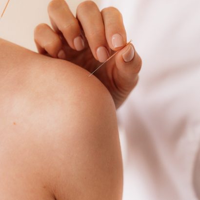Acupuncture needles in points on shoulder.